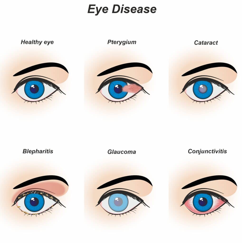 Comparison of healthy eyes and eyes needing treatment